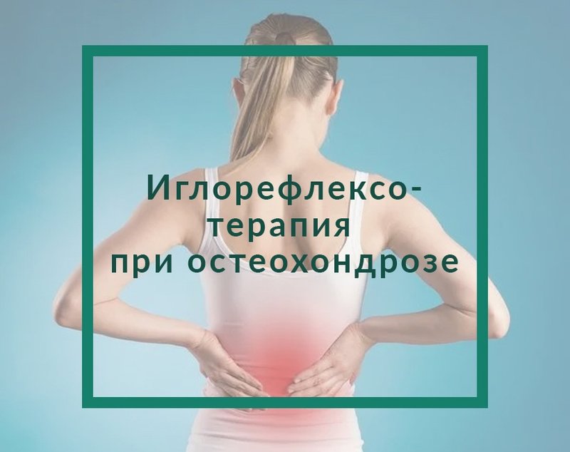 Иглорефлексотерапия при остеохондрозе
