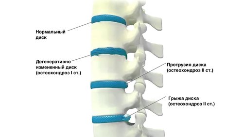 грыжи и протрузии