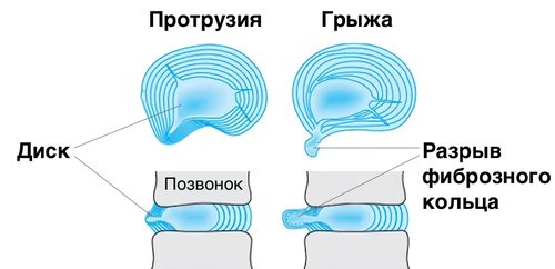 Отличие грыжи от протрузии