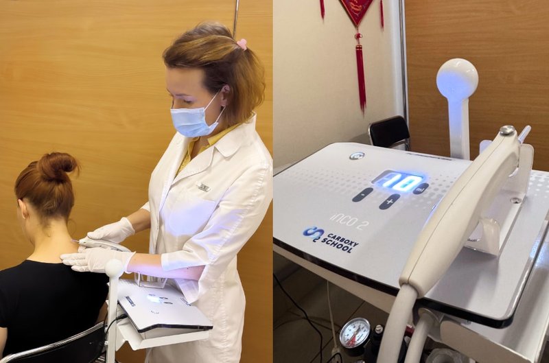 Карбокситерапия