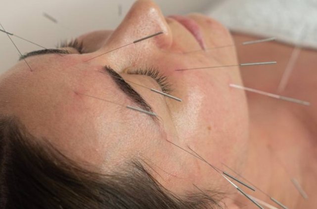 неврит лицевого нерва